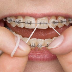 Flossing with braces