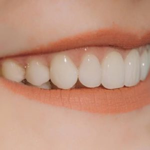 زیبا سازی دندان با لمینت دندان | شرکت ستاره گنبد مینا