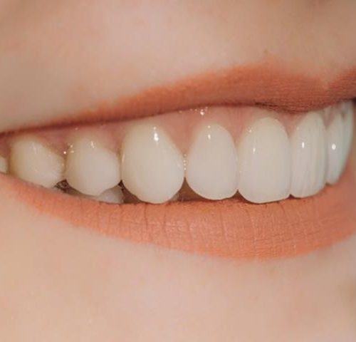 زیبا سازی دندان با لمینت دندان | شرکت ستاره گنبد مینا