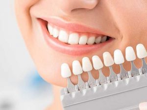 زیباسازی دندان | لمینت دندان | شرکت ستاره گنبد مینا