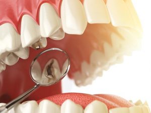 پوسیدگی دندان | شرکت ستاره گنبد مینا