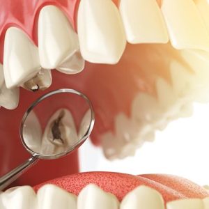 پوسیدگی دندان | شرکت ستاره گنبد مینا