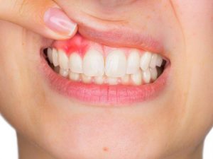 آبسه دندان | بیماری دهان و دندان | شرکت ستاره گنبد مینا