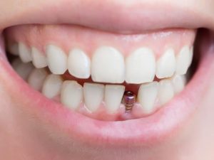 ایمپلنت دندان | شرکت ستاره گنبد مینا