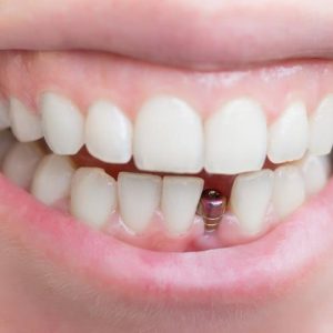 ایمپلنت دندان | شرکت ستاره گنبد مینا