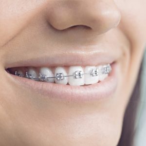 ارتودنسی چیست | نخ دندان مینا