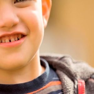 وجود فاصله بین دندان ها | شرکت ستاره گنبد مینا