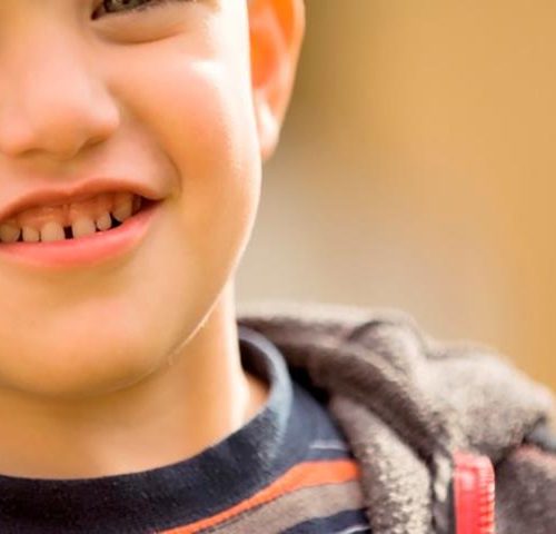 وجود فاصله بین دندان ها | شرکت ستاره گنبد مینا