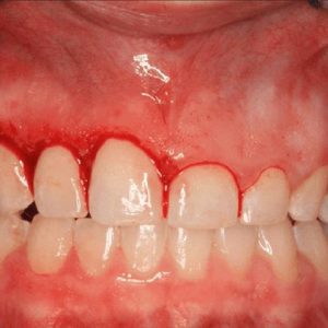 جراحی لیفت لثه | شرکت ستاره گنبد مینا