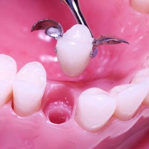 پل دندان مریلند | شرکت ستاره گنبد مینا