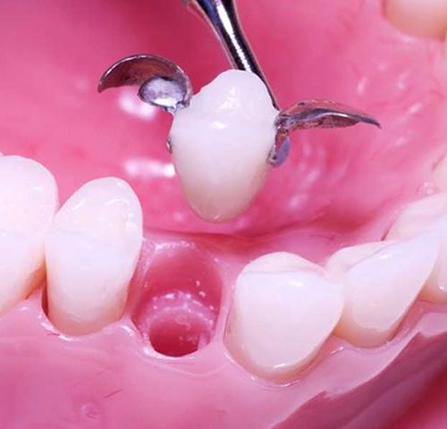 پل دندان مریلند | شرکت ستاره گنبد مینا
