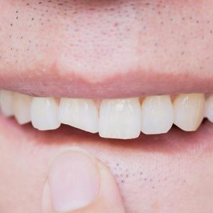 انواع کامپوزیت دندان | شرکت ستاره گنبد مینا