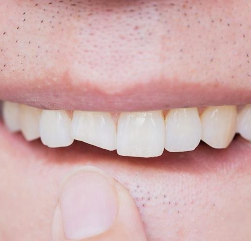 انواع کامپوزیت دندان | شرکت ستاره گنبد مینا