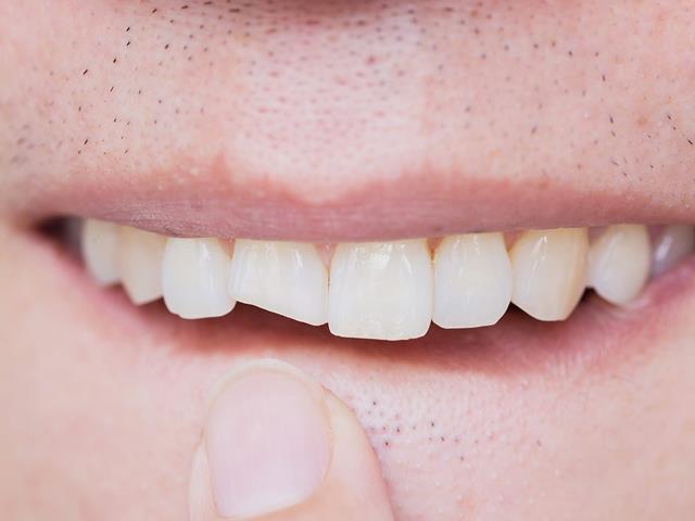 انواع کامپوزیت دندان | شرکت ستاره گنبد مینا