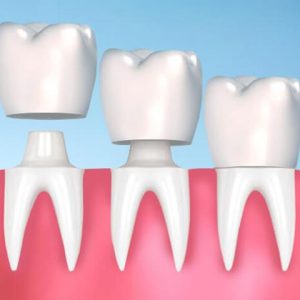 سوار کردن روکش دندان | شرکت ستاره گنبد مینا