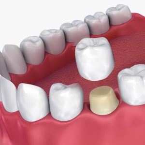 انواع روکش دندان | شرکت ستاره گنبد مینا