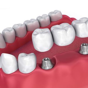 بریج یا پل دندان | نخ دندان مینا