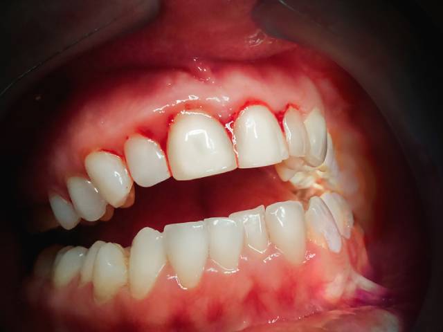 انواع بیماری های لثه | نخ دندان مینا