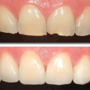 ترمیم شکستگی دندان با کامپوزیت | شرکت ستاره گنبد مینا