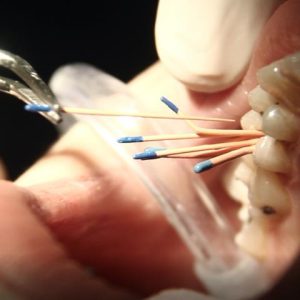 عصب کشی دندان یا روت کانال | نخ دندان مینا