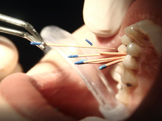 عصب کشی دندان یا روت کانال | نخ دندان مینا
