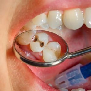 روش های درمان پوسیدگی دندان | نخ دندان مینا