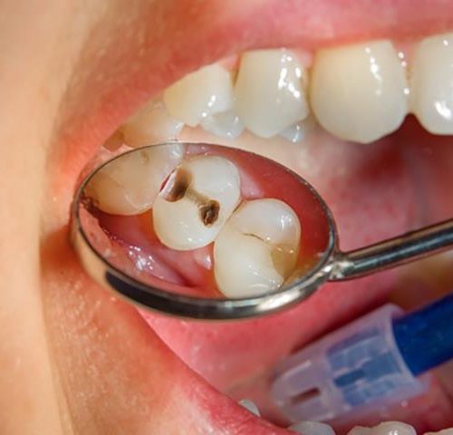 روش های درمان پوسیدگی دندان | نخ دندان مینا