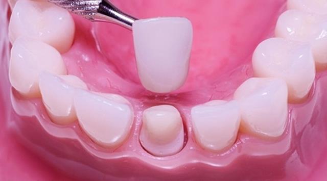 درمان پوسیدگی با روکش کردن دندان | نخ دندان مینا