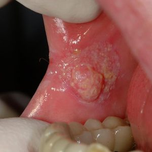 سرطان دهان | نخ دندان مینا | شرکت ستاره گنبد مینا