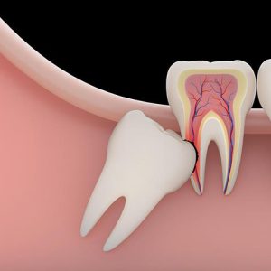 فشار دندان عقل به دندان های مجاور | شرکت ستاره گنبد مینا