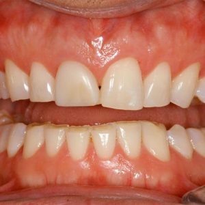 دندان قروچه با بروکسیسم | نخ دندان مینا