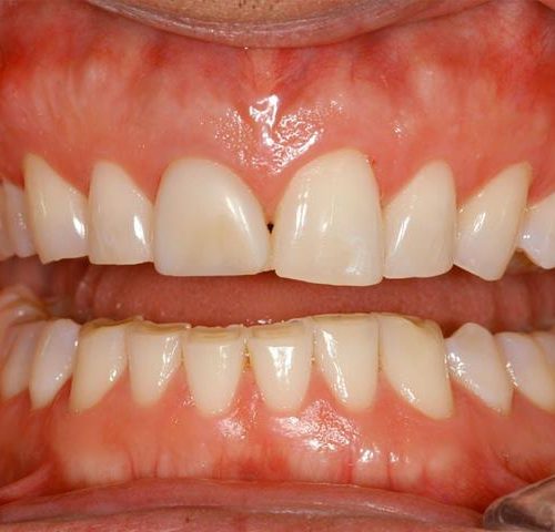 دندان قروچه با بروکسیسم | نخ دندان مینا
