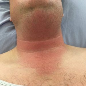 بیماری آنژین لودویگ | نخ دندان مینا