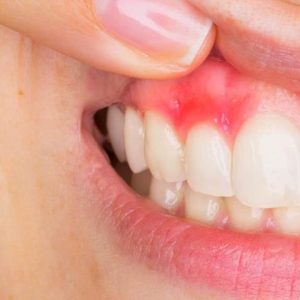 آبسه دندان | نخ دندان مینا