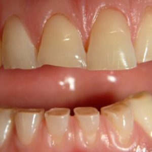 ساییدگی دندان | شرکت ستاره گنبد مینا