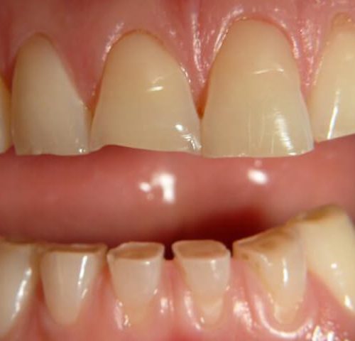 ساییدگی دندان | شرکت ستاره گنبد مینا