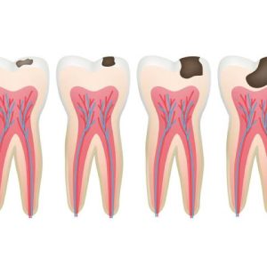 مراحل پوسیدگی دندان | نخ دندان مینا