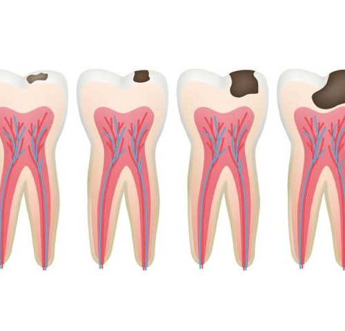 مراحل پوسیدگی دندان | نخ دندان مینا