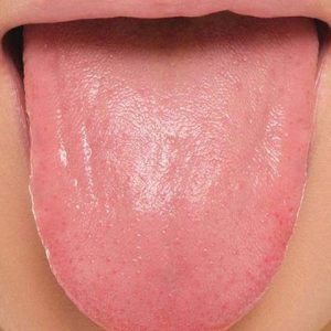 انواع بیماری های زبان | نخ دندان مینا