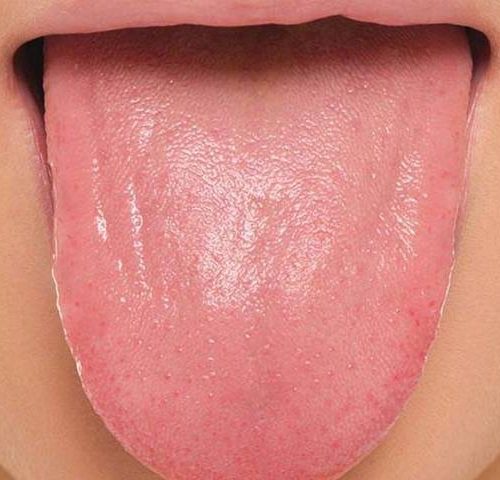 انواع بیماری های زبان | نخ دندان مینا