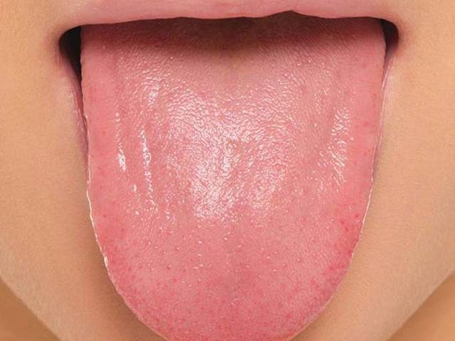 معرفی شایع ترین انواع بیماری های زبان | شرکت نخ دندان مینا