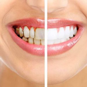 بیماری آماس لثه | نخ دندان مینا