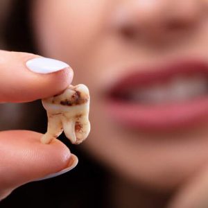 نقش مواد غذایی در پوسیدگی دندان | نخ دندان مینا