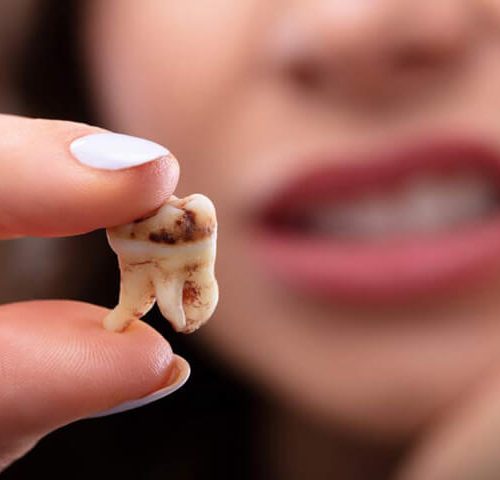 نقش مواد غذایی در پوسیدگی دندان | نخ دندان مینا