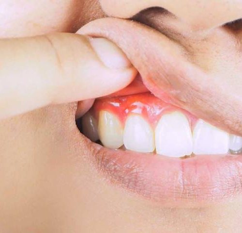 بیماری پریودنتیت یا التهاب مزمن لثه | نخ دندان مینا