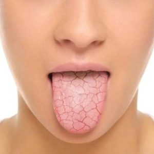 علل بیماری خشکی دهان | نخ دندان مینا