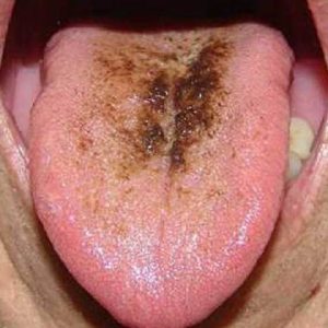 عکس زبان سیاه مودار | نخ دندان مینا