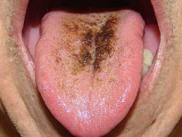 بیماری زبان سیاه مودار ، نوعی بیماری خوش خیم | نخ دندان مینا
