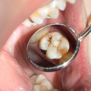 علائم فرسایش مینای دندان | نخ دندان مینا