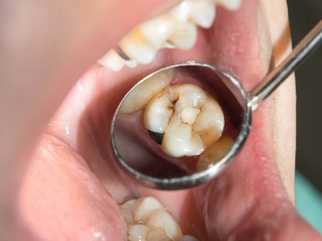 علائم فرسایش مینای دندان | نخ دندان مینا